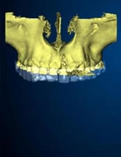 港区 虎ノ門 虎ノ門ワールドゲート歯科 神谷町駅前 3D画像を構築する唇側の骨欠損が広範囲に及んでいる