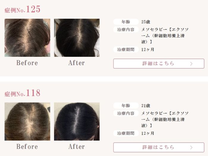 リアスクリニック20代女性薄毛治療症例