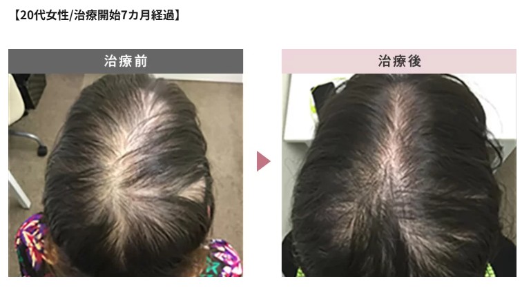 スマイルAGAクリニック20代女性薄毛治療症例