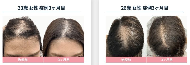 DrAGAクリニック20代女性症例