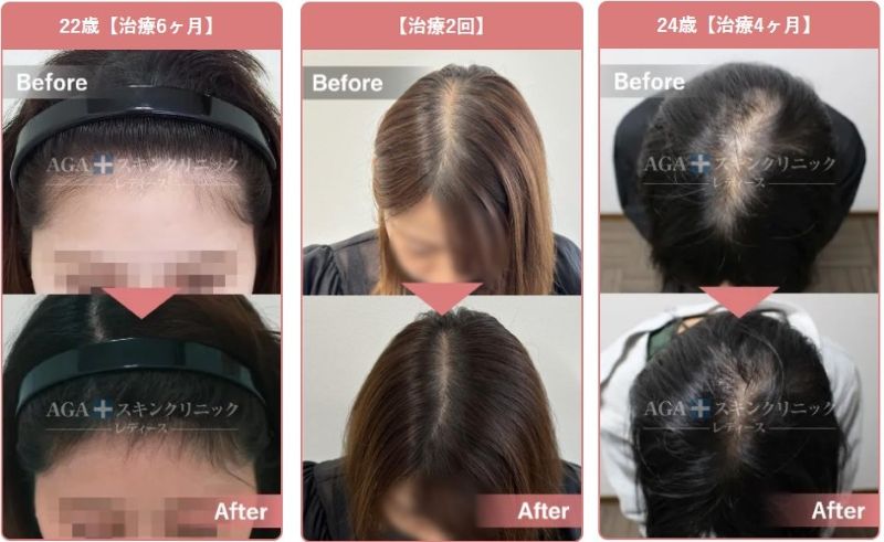 AGAスキンクリニック20代女性薄毛治療症例
