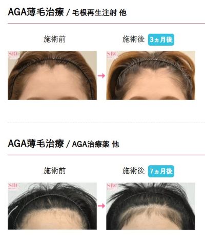 SBC20代女性薄毛治療症例
