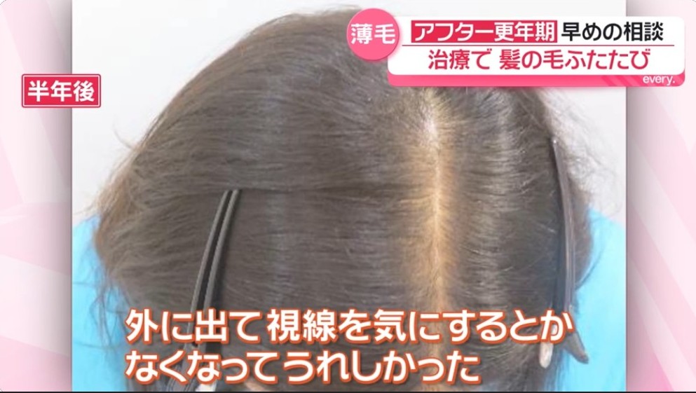 クレアージュ女性の薄毛治療口コミ（60代女性）