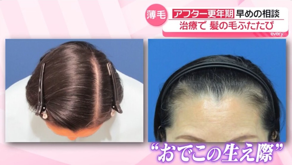 クレアージュ女性の薄毛治療口コミ（66歳北原さん）