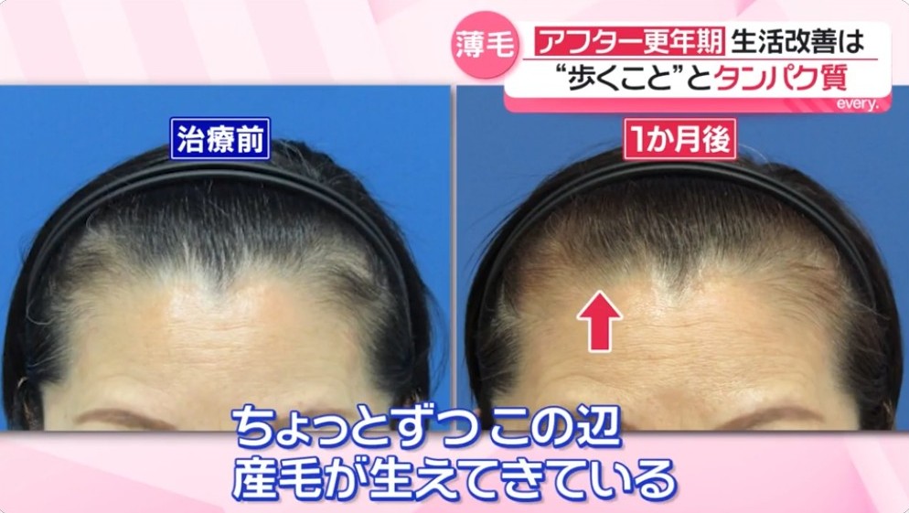 クレアージュ東京女性の薄毛治療効果